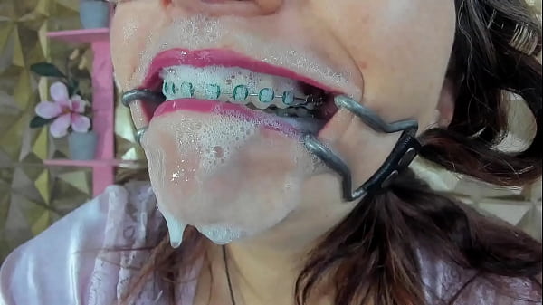 mouth tongue braces teeth by auro smith chaturbate.com